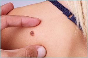 MELANOMA SKIN CANCER