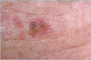 SQUAMOUS CELL CARCINOMA SKIN CANCER DETECTION