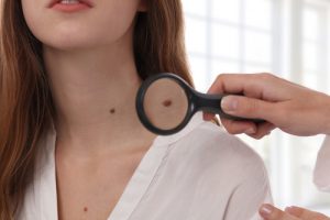 Mole evaluation near Havertown