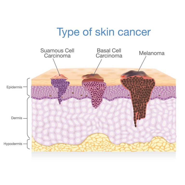 Melanoma Vs Basal Cell Skin Cancer