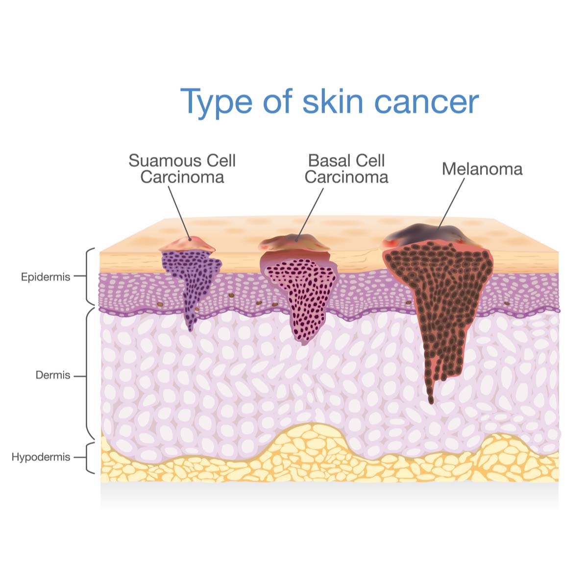 Examples Of Skin Cancer Types 