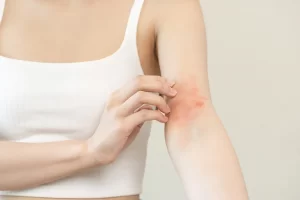 Eczema and atopic dermatitis treatment at Bala Dermatology on the Main Line, PA